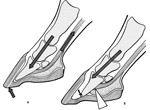 Tendon