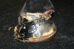medial displacement